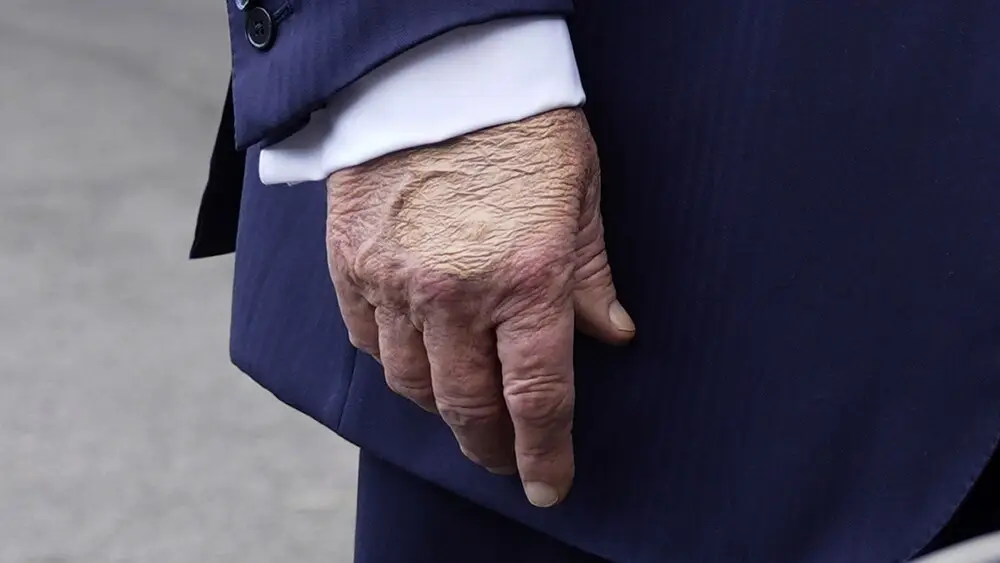 Trump concealing bruise on hand with makeup